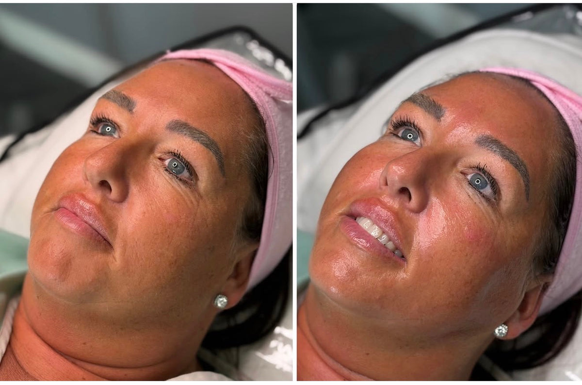 before and after results of Pink Drop skin booster on a womans face