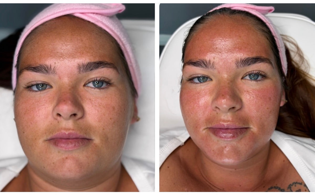 before and after results of Pink Drop skin booster on a womans face