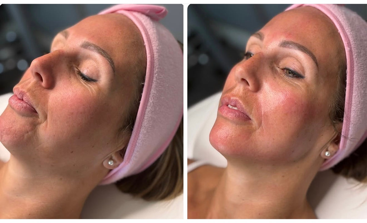 before and after results of Pink Drop skin booster on a womans face